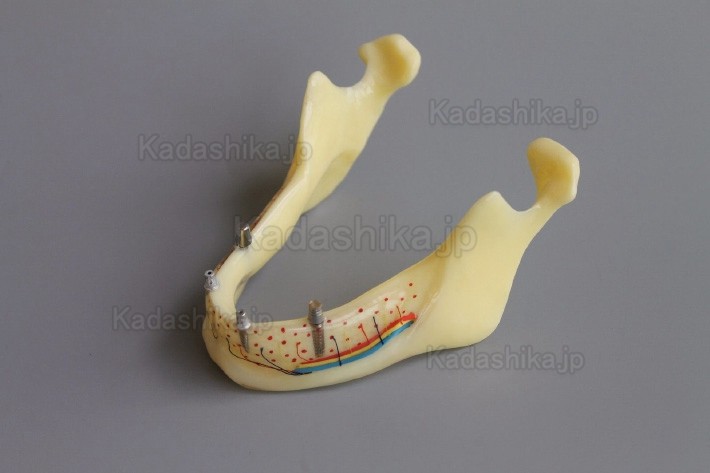 下顎骨組織とインプラント模型 + オーバーデンチャーモデル ＃2014 02