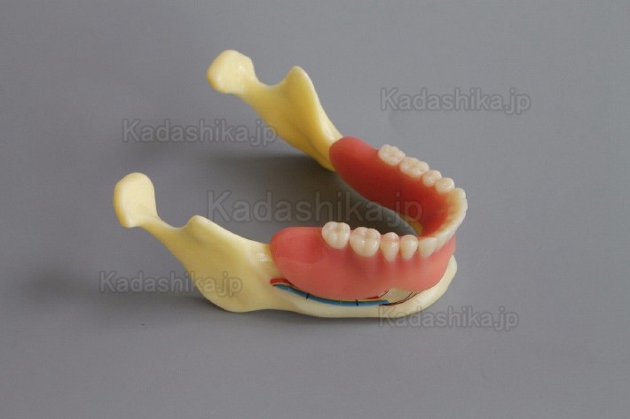 下顎骨組織とインプラント模型 + オーバーデンチャーモデル ＃2014 02