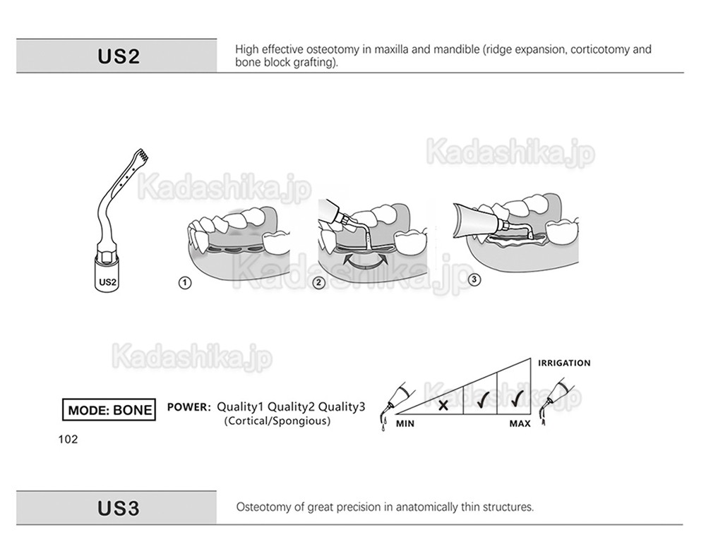 歯科ピエゾサージェリーチップ US1 US1L US1R US2 US3 US4 US5 US6 US7 US11 US12 (Mectron Woodpeckerに適用)